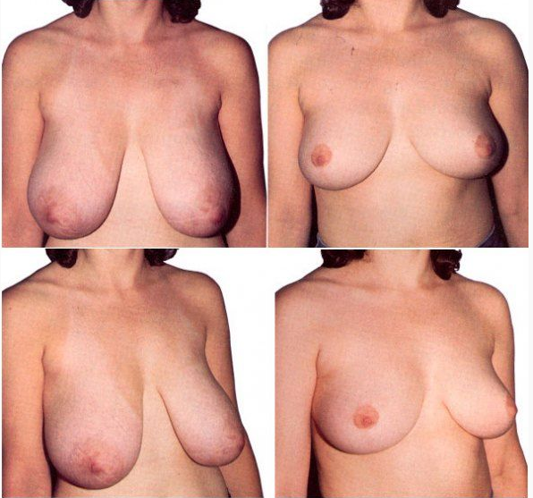 Пластика по уменьшению груди (редукционная. маммопластика. Функциональные