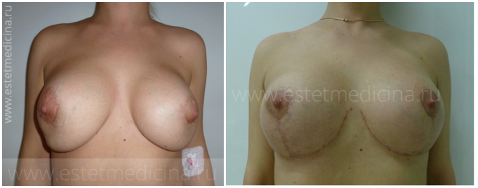 увеличение груди без подтяжки - осложнения