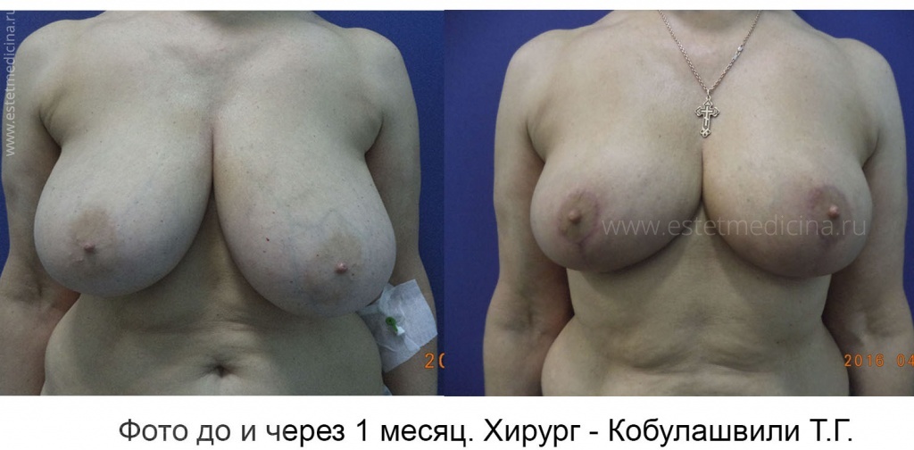 Уменьшение груди, хирург Тимур Кобулашвили. Фото до и после