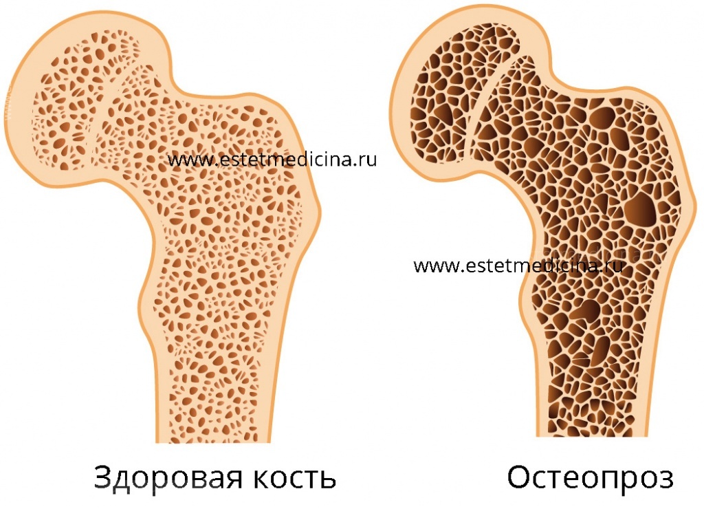 Остеопороз костей