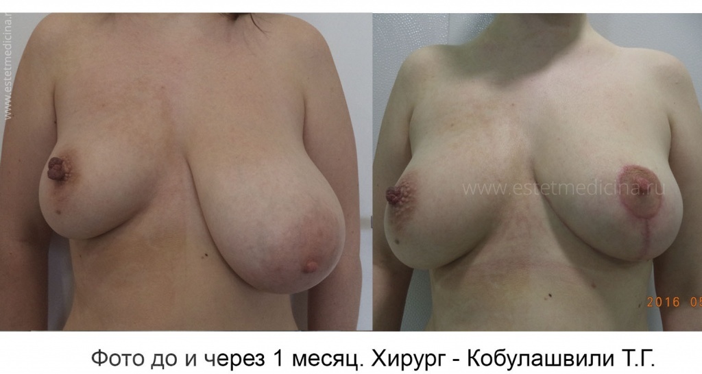 Уменьшение одной груди, асимметрия груди. Хирург Тимур Кобулашвили