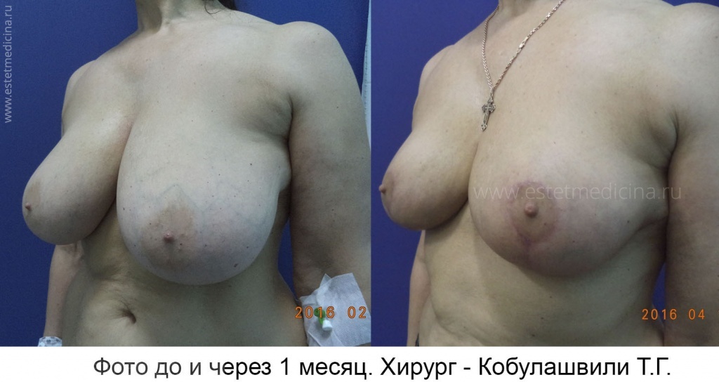 Хирург Тимур Кобулашвили. Фото до и после редукционной маммопластики