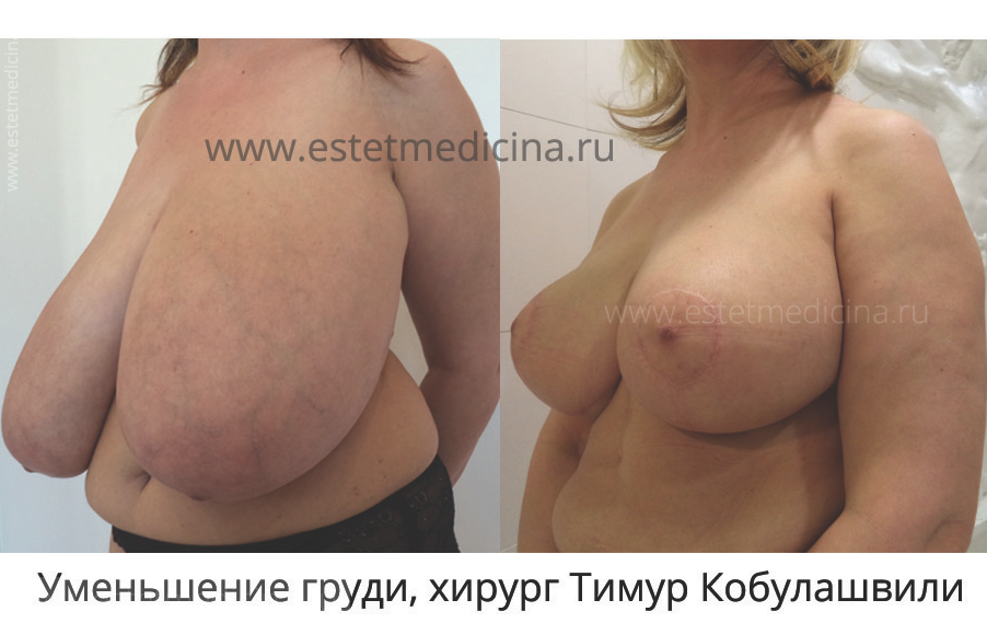 Уменьшение груди фото до и после, хирург Тимур Кобулашвили