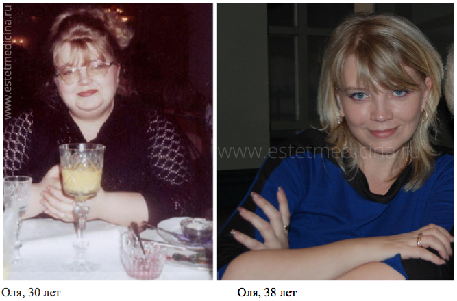 Пациентка др. Гагариной - Ольга до и после 