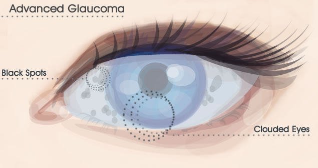 Глаукома заболевание