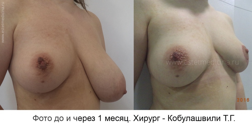 Уменьшение одной груди. Хирург Тимур Кобулашвили. Асимметрия груди фото до и после