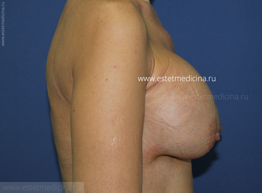 увеличение груди осложнения фото