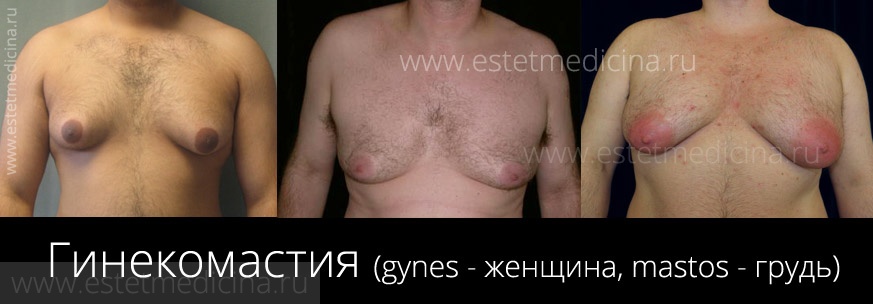 Гинекомастия фото, грудь у мужчин фото