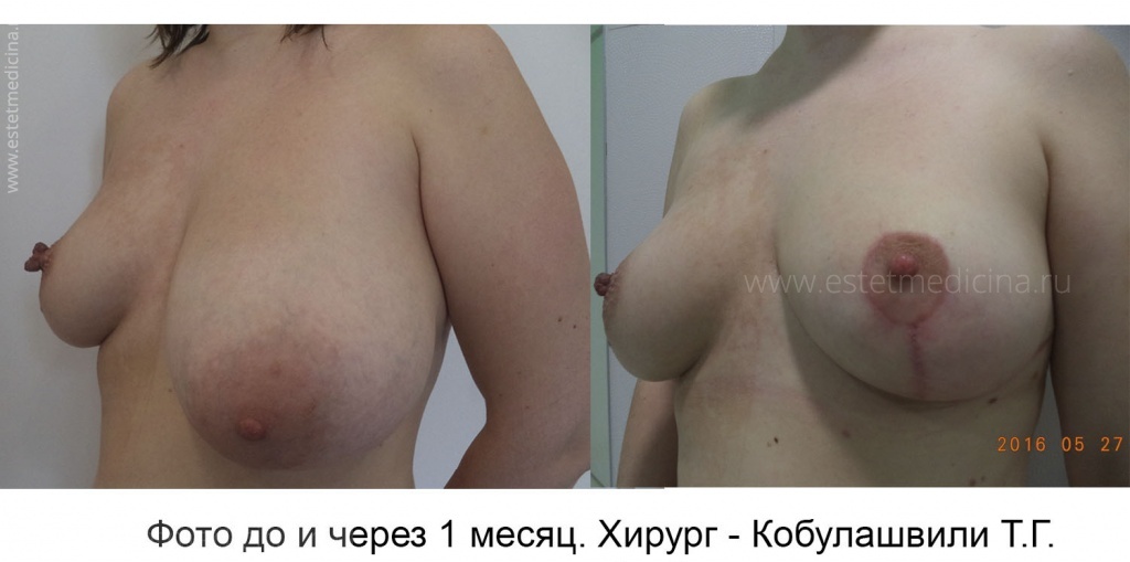Уменьшение одной груди, хирург Тимур Кобулашвили. Фото до и после через 1 месяц. Асимметрия груди фото