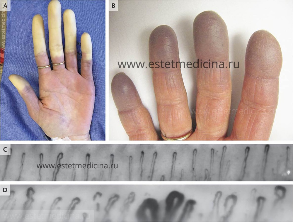 Болезнь Рейно вид пальцев рук