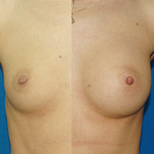 Блохин Сергей Николаевич, увеличение груди через подмышку до и после