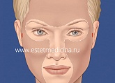 Разрезы при эндоскопии лба и средней зоны лица при омоложении пациента с небольшим избытком тканей