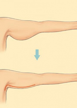 Брахиопластика - подтяжка рук