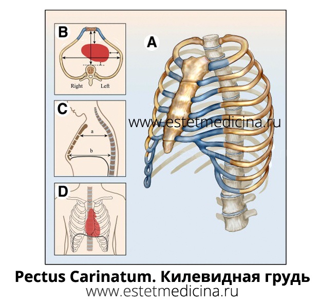 pectus carinatum, килевидная грудная клетка