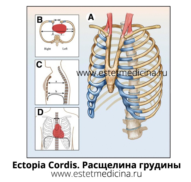 Ectopia Cordis, Cleft Sternum. Врожденная расщелина грудины