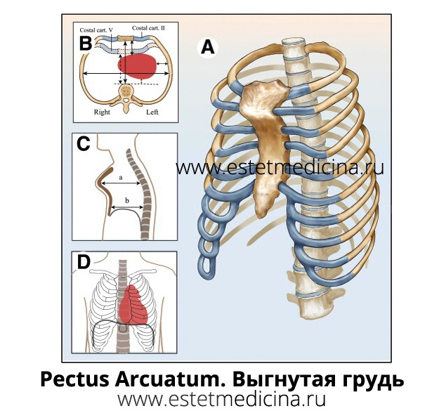 pectus arcuatum, выгнутая грудная клетка, Pouter Pigeon, Horns of steer, Синдром Куррарино Сильвермана