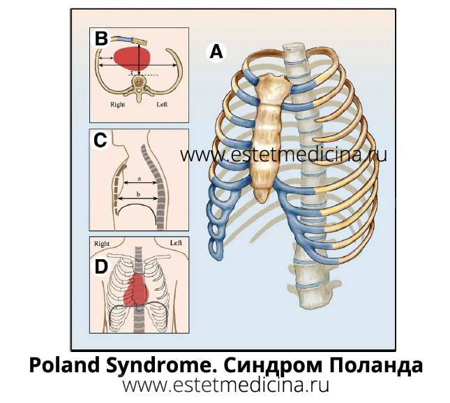 poland syndrome, синдром поланда с отсутсвием ребер