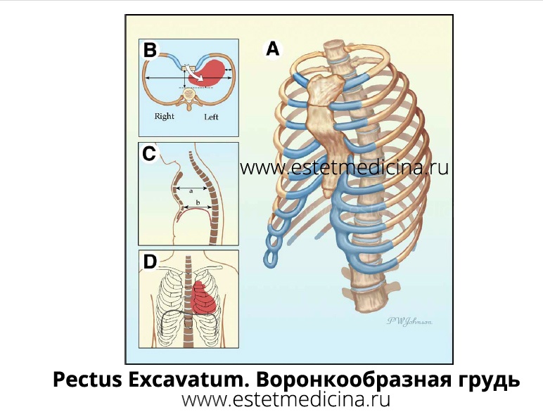 pectus excavatum, воронкообразная грудная клетка, воронкообразная грудь