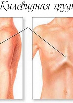 Килевидная деформация грудной клетки: причины, лечение, операция