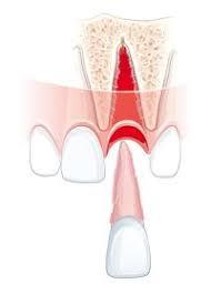 Пересадка зубов