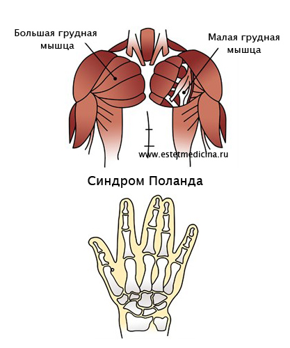 Синдром Поланда