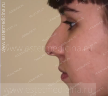 До ринопластики До ринопластики
