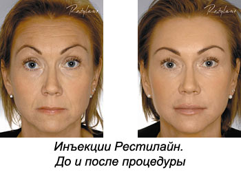 до и после контурной пластики лица