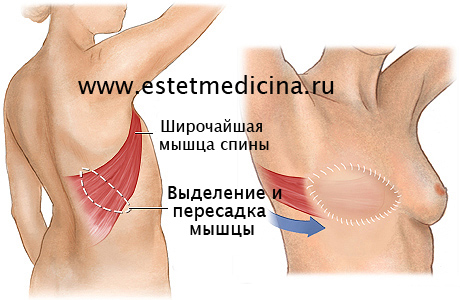 Пересадка мышцы со спины при Синдроме Поланда