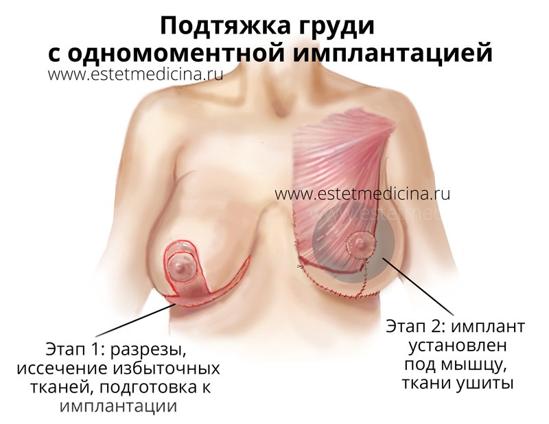 Подтяжка груди с имплантами