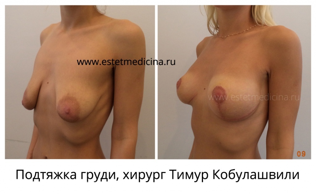 Подтяжка груди (мастопексия) хирург Тимур Кобулашвили фото до и после операции