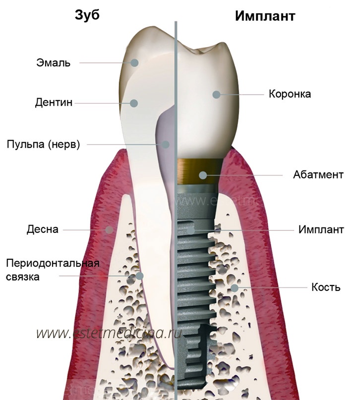 строение зубного импланта