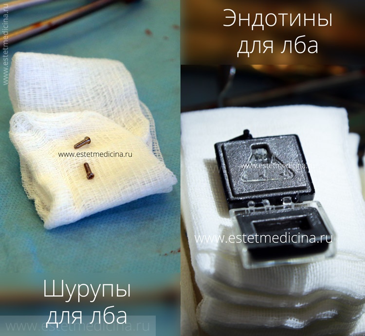 Эндоскопия лба: шурупы или эндотины