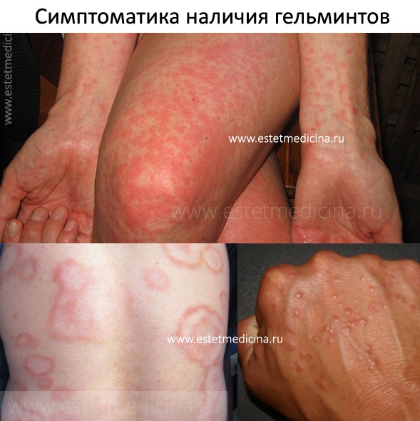 Паразиты человека : инфекционные заболевания