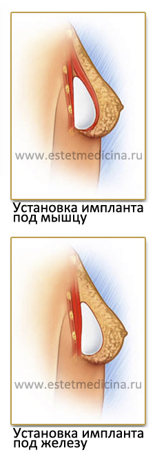 Варианты установки имплантов груди: под мышцу и под мышцу