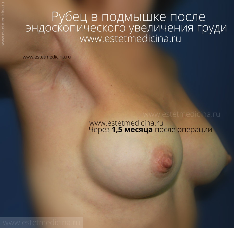 Рубец в подмышке после увеличения груди 1,5 месяца