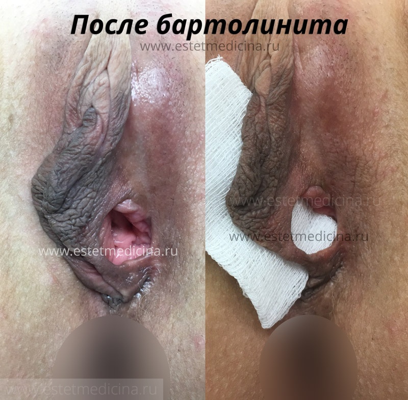 После бартолинита, разрыв половых губ