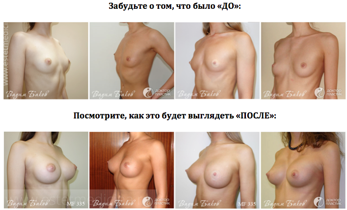 Баков Вадим Сергеевич фото до и после увеличения груди
