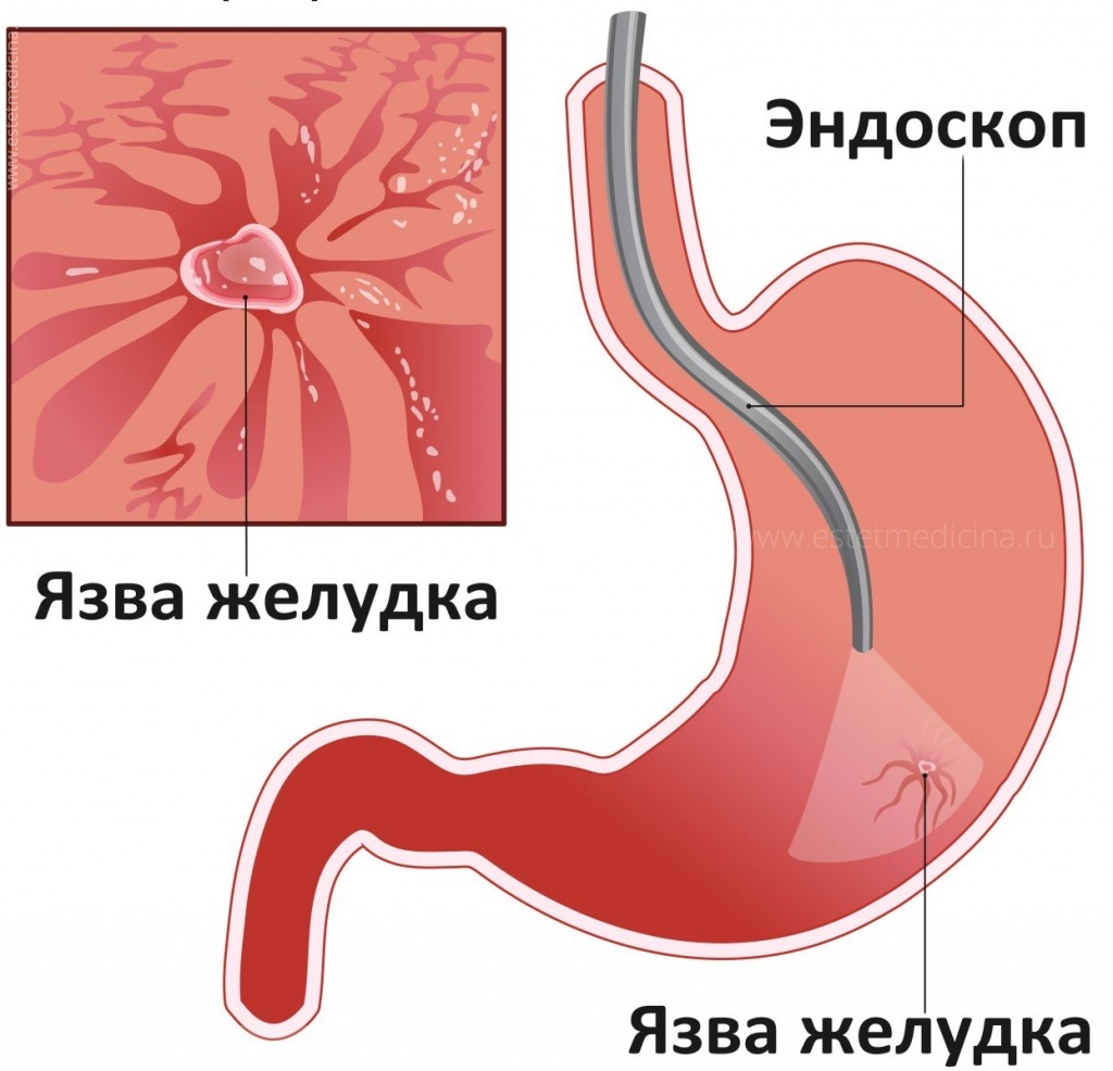 Язва желудка и двенадцатиперстной кишки: причины, лечение, диета |  Интернет-журнал Estetmedicina.ru