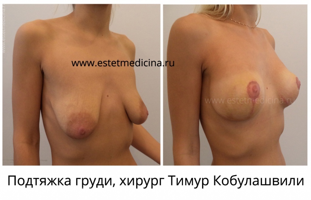 Подтяжка груди (мастопексия) хирург Тимур Кобулашвили фото до и после