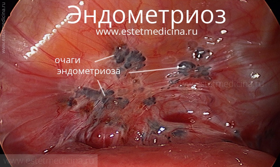 Эндометриоз матки лечение, причины | Интернет-журнал Estetmedicina.ru
