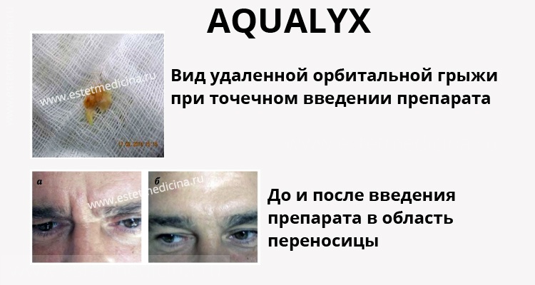 AQUALYX, Акваликс