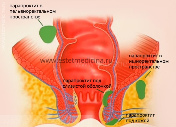 Парапроктит лечение и симптомы