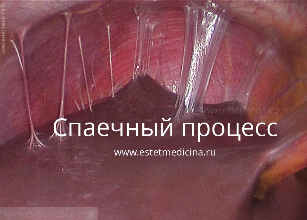 Лечение спаек в малом тазу, спаечного процесса - Москва