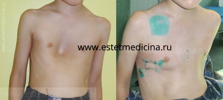 Воронкообразная грудная клетка у ребенка фото до и после лечения. Впалая грудь у ребенка