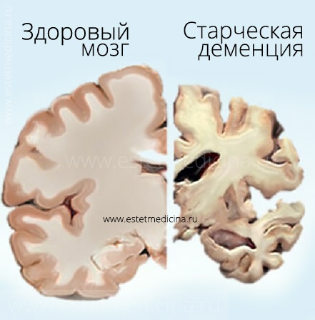 Деменция — старческое слабоумие