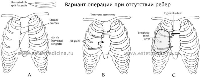 Отсутствие ребер при Синдроме Поланда