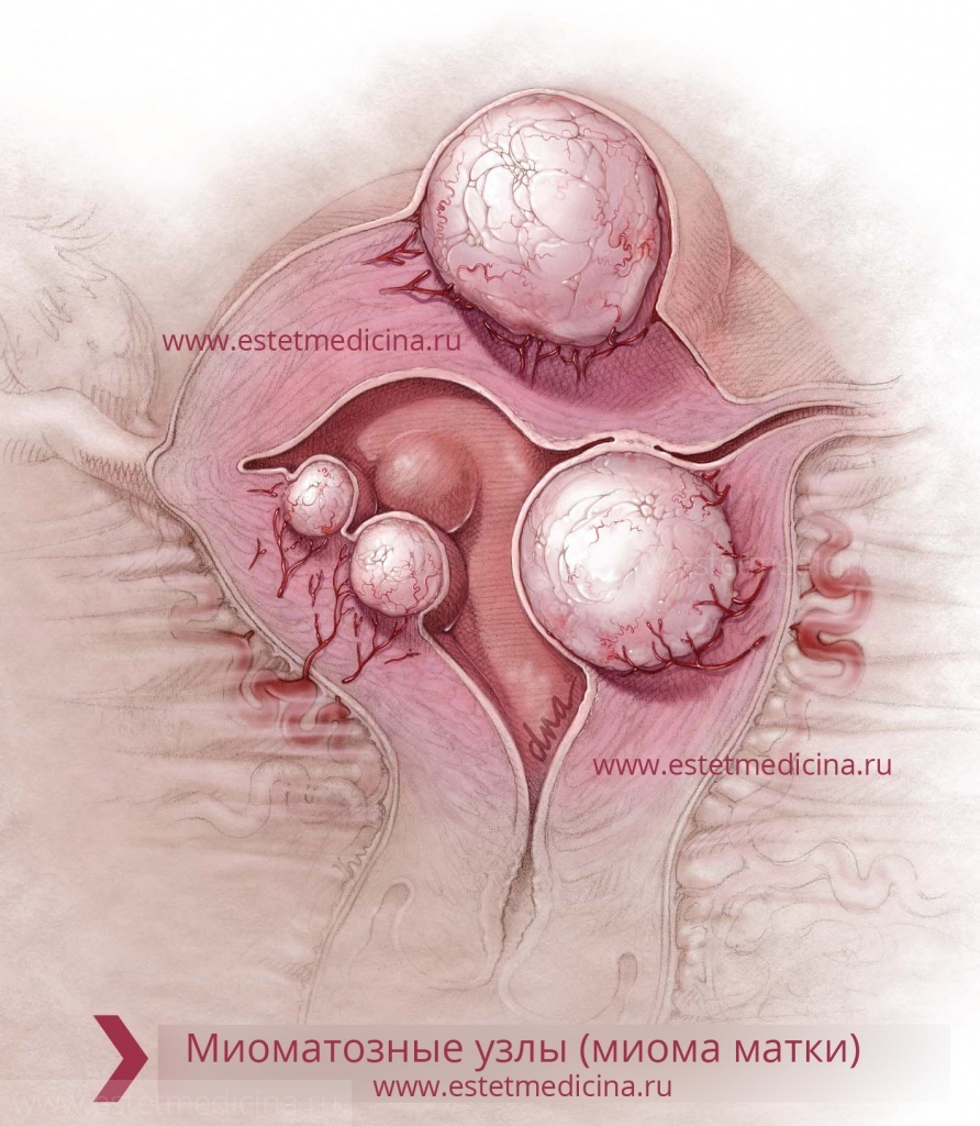 Лечение миомы матки: что делать? Лапароскопия | Интернет-журнал  Estetmedicina.ru