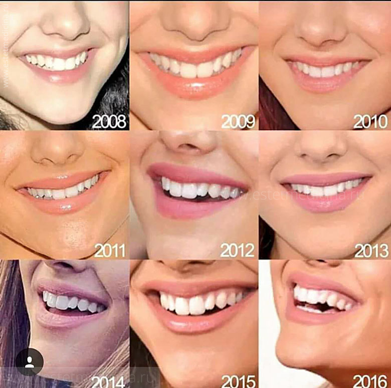 Ариана Гранде улыбка зубы