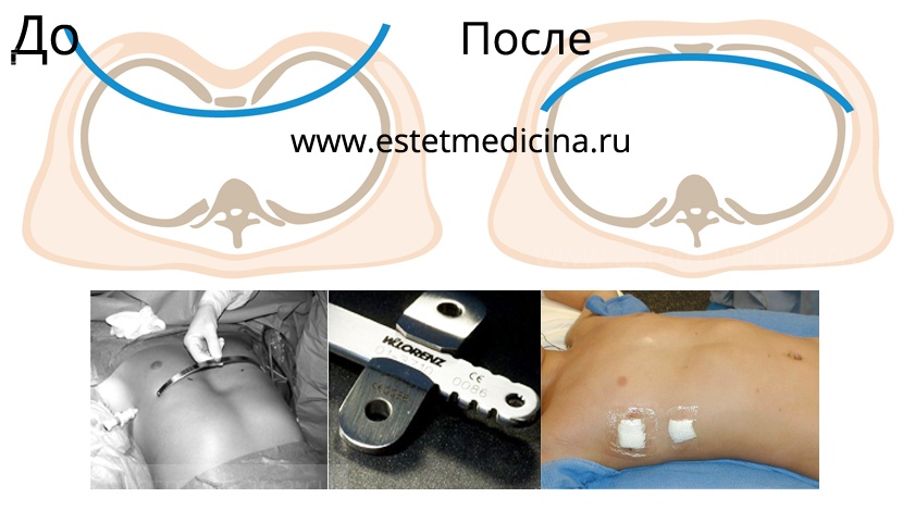 Лечение впалой груди у ребенка фото операции Насса, Nuss Procedure 