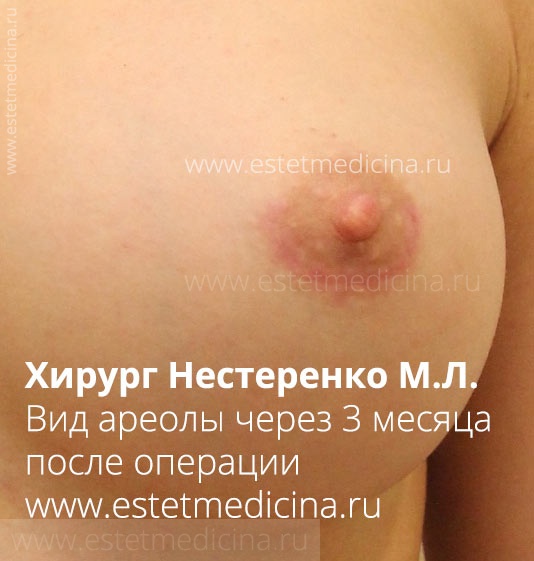 Ареола после увеличения груди: вид рубца через 3 месяца